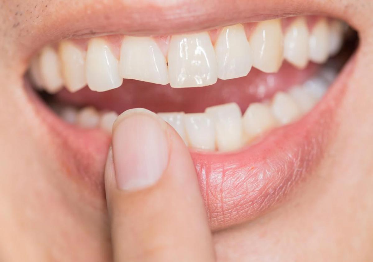 Are There Options For Repairing Severely Damaged Teeth?