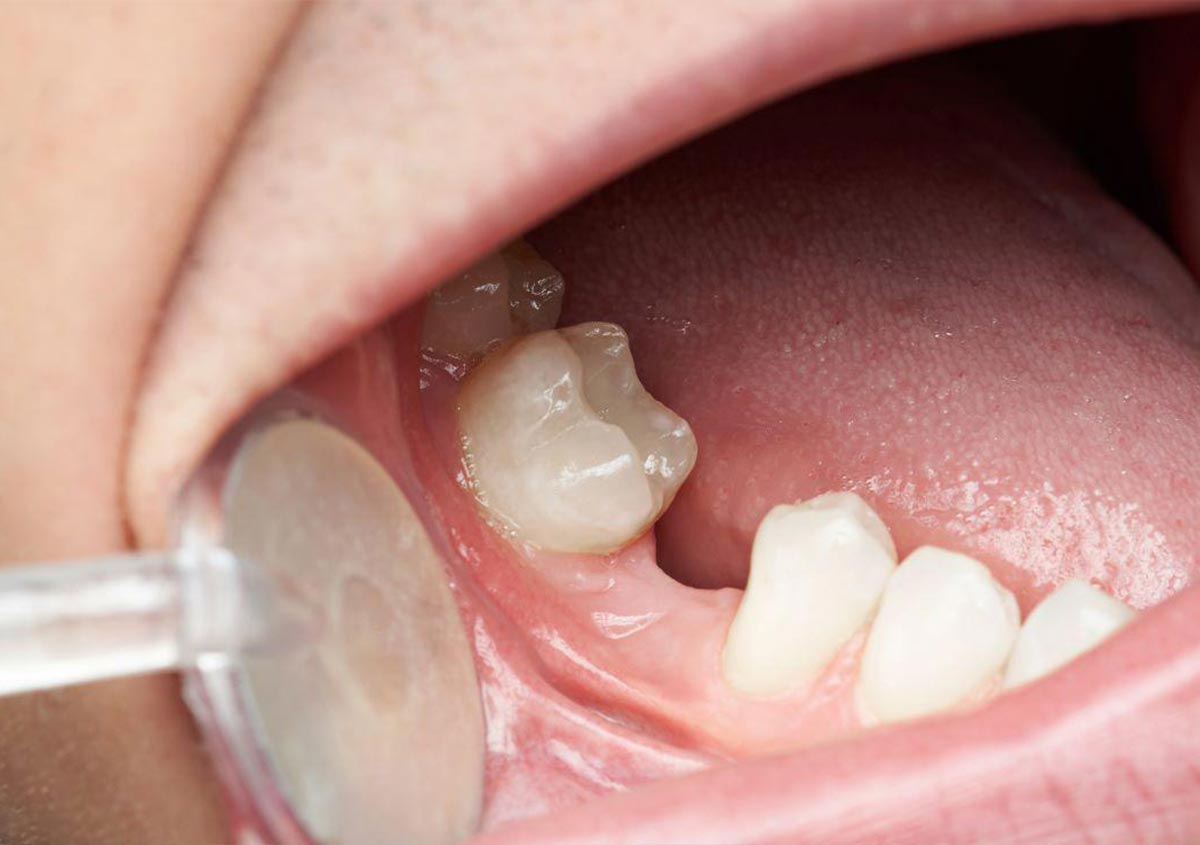 Do I Need To Replace A Missing Tooth?