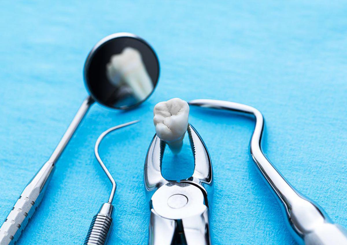 5 Common Reasons For A Tooth Extraction