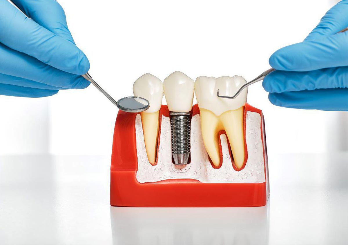 5 Mistakes to Avoid with Dental Implants